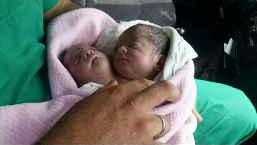 حالة طبية نادرة في إدلب بسوريا