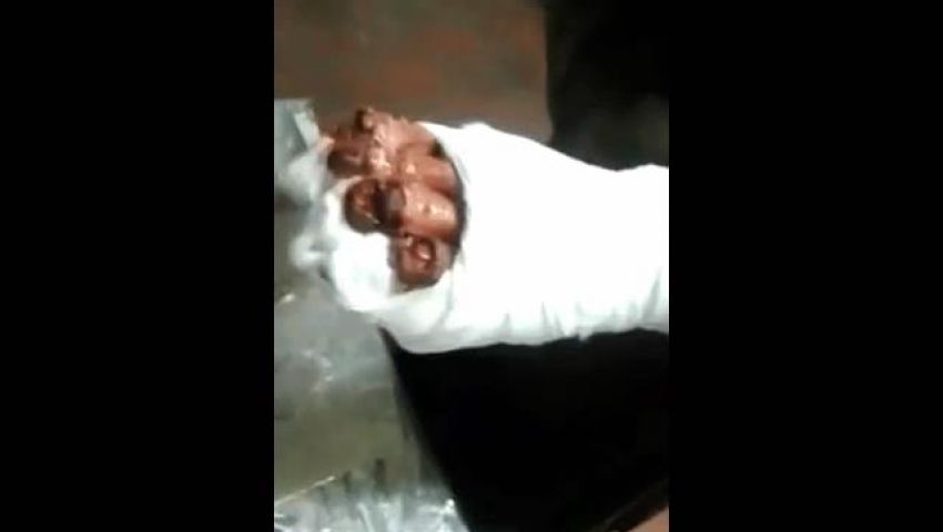 بالصور.. للمرة الثانية ضبط متسول يدعى بتر اصابعه بالمترو
