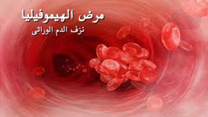 مرضى الهيموفيليا: أسعار الأدوية نار.. والصحة تعاملنا كمتسولين