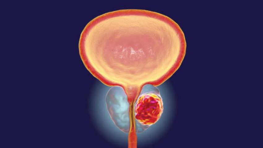 عقار جديد يثبت فاعليته في علاج سرطان البروستاتا