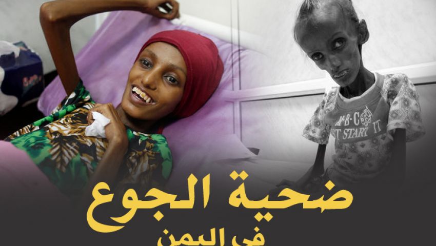 بالصور.. شعاع أمل لسعيدة ضحية الجوع في اليمن