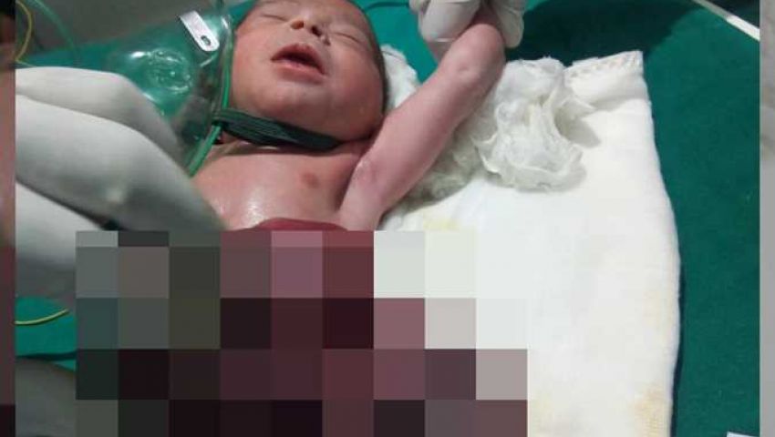 بالصور| نجاح عملية جراحة نادرة لطفلة عمرها 3 ساعات ولدت دون جدار بطن أمامي